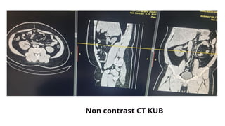 Non contrast CT KUB
 