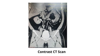 Contrast CT Scan
 