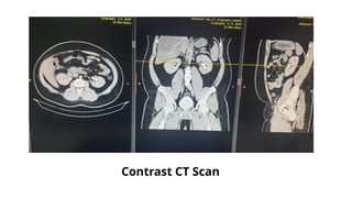 Contrast CT Scan
 