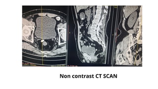 Non contrast CT SCAN
 