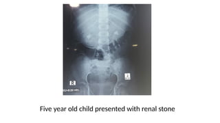Five year old child presented with renal stone
 