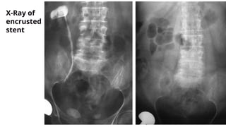 X-Ray of
encrusted
stent
 
