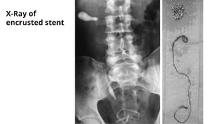 X-Ray of
encrusted stent
 