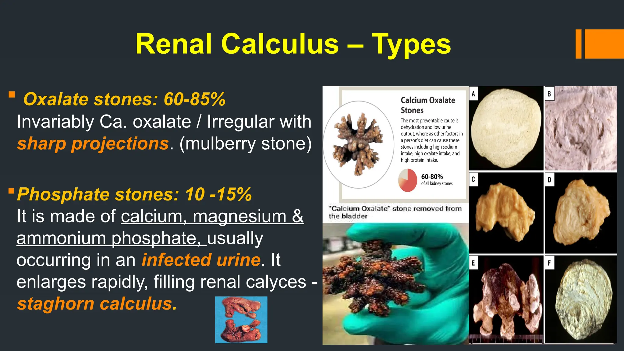 Renal Calculus – Types
 Oxalate stones: 60-85%
Invariably Ca. oxalate / Irregular with
sharp projections. (mulberry stone)
Phosphate stones: 10 -15%
It is made of calcium, magnesium &
ammonium phosphate, usually
occurring in an infected urine. It
enlarges rapidly, filling renal calyces -
staghorn calculus.
 