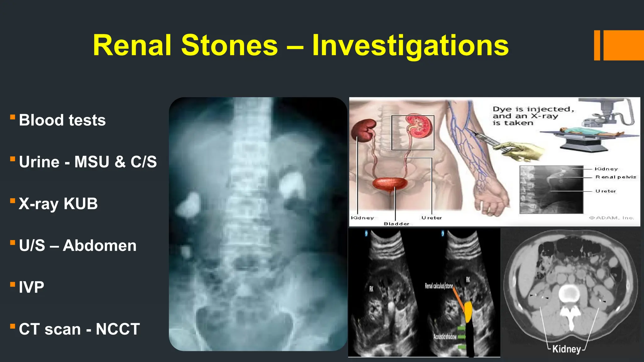 Renal Stones – Investigations
Blood tests
Urine - MSU & C/S
X-ray KUB
U/S – Abdomen
IVP
CT scan - NCCT
 