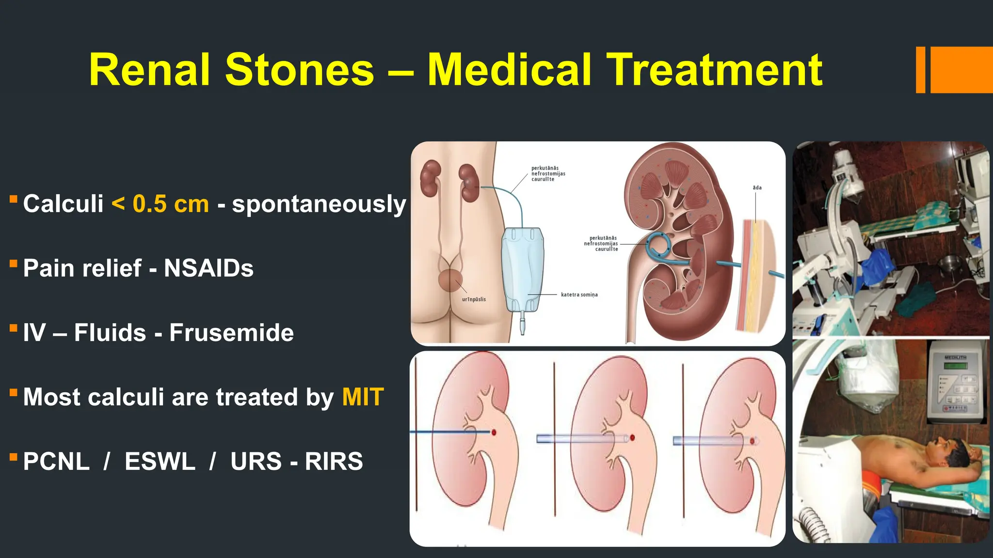 Renal Stones – Medical Treatment
Calculi < 0.5 cm - spontaneously
Pain relief - NSAIDs
IV – Fluids - Frusemide
Most calculi are treated by MIT
PCNL / ESWL / URS - RIRS
 