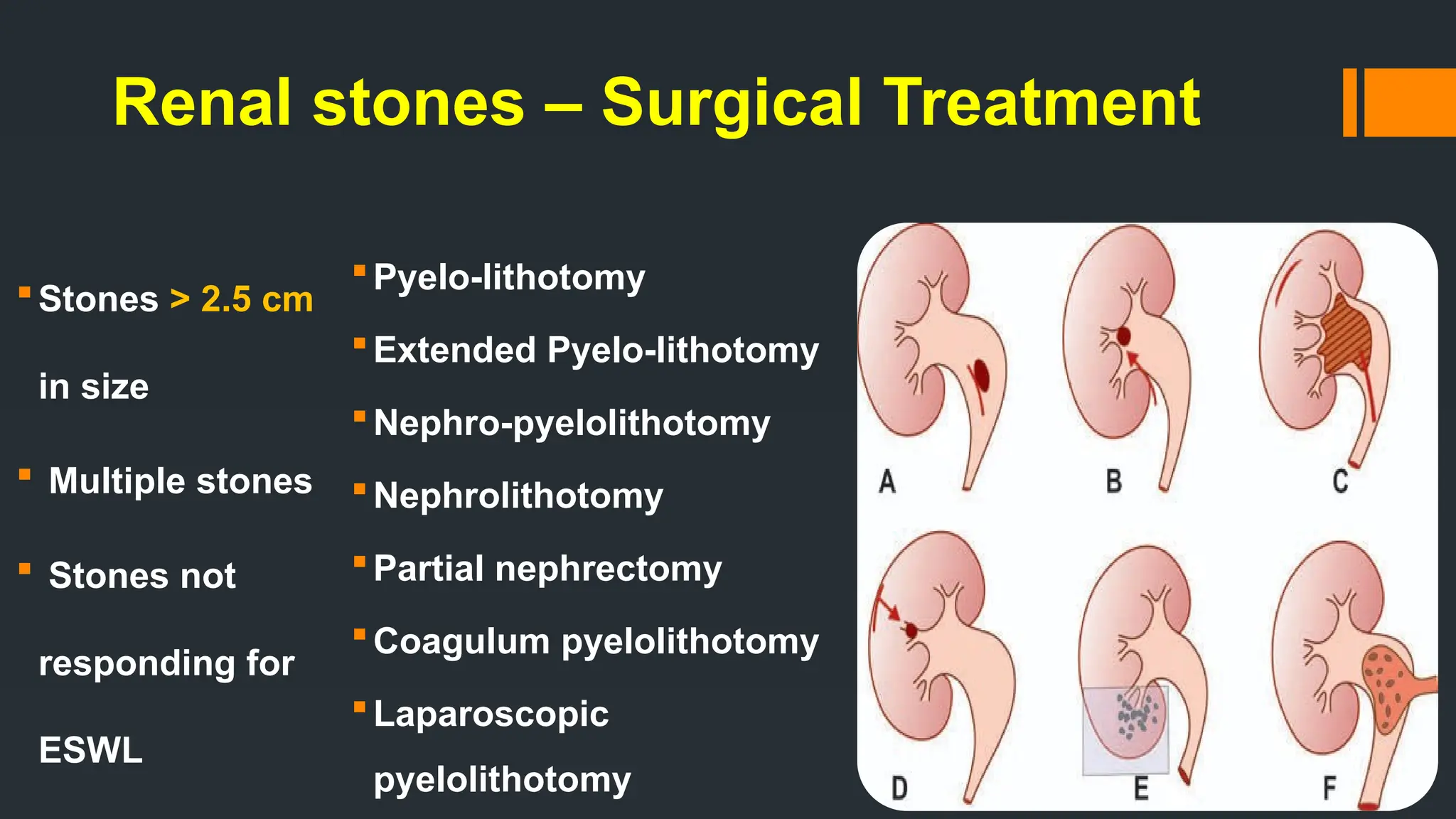 Renal stones – Surgical Treatment
Stones > 2.5 cm
in size
 Multiple stones
 Stones not
responding for
ESWL
Pyelo-lithotomy
Extended Pyelo-lithotomy
Nephro-pyelolithotomy
Nephrolithotomy
Partial nephrectomy
Coagulum pyelolithotomy
Laparoscopic
pyelolithotomy
 