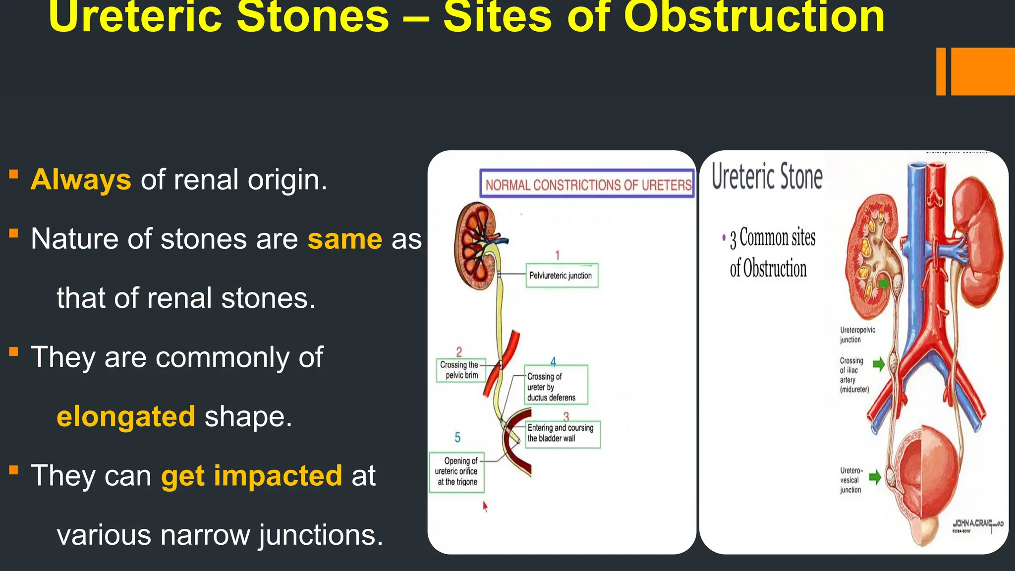 Ureteric Stones – Sites of Obstruction
 Always of renal origin.
 Nature of stones are same as
that of renal stones.
 They are commonly of
elongated shape.
 They can get impacted at
various narrow junctions.
 