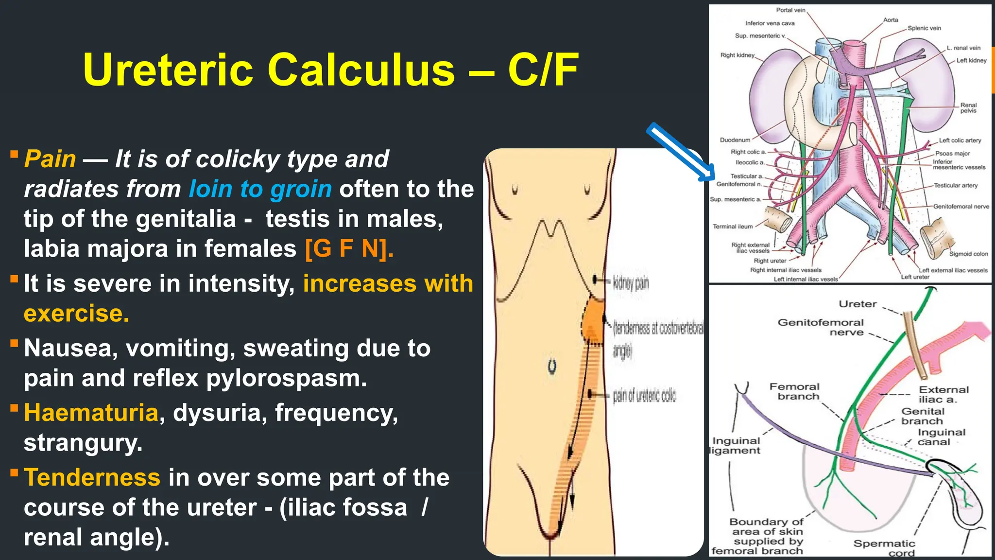 Ureteric Calculus – C/F
Pain — It is of colicky type and
radiates from loin to groin often to the
tip of the genitalia - testis in males,
labia majora in females [G F N].
It is severe in intensity, increases with
exercise.
Nausea, vomiting, sweating due to
pain and reflex pylorospasm.
Haematuria, dysuria, frequency,
strangury.
Tenderness in over some part of the
course of the ureter - (iliac fossa /
renal angle).
 