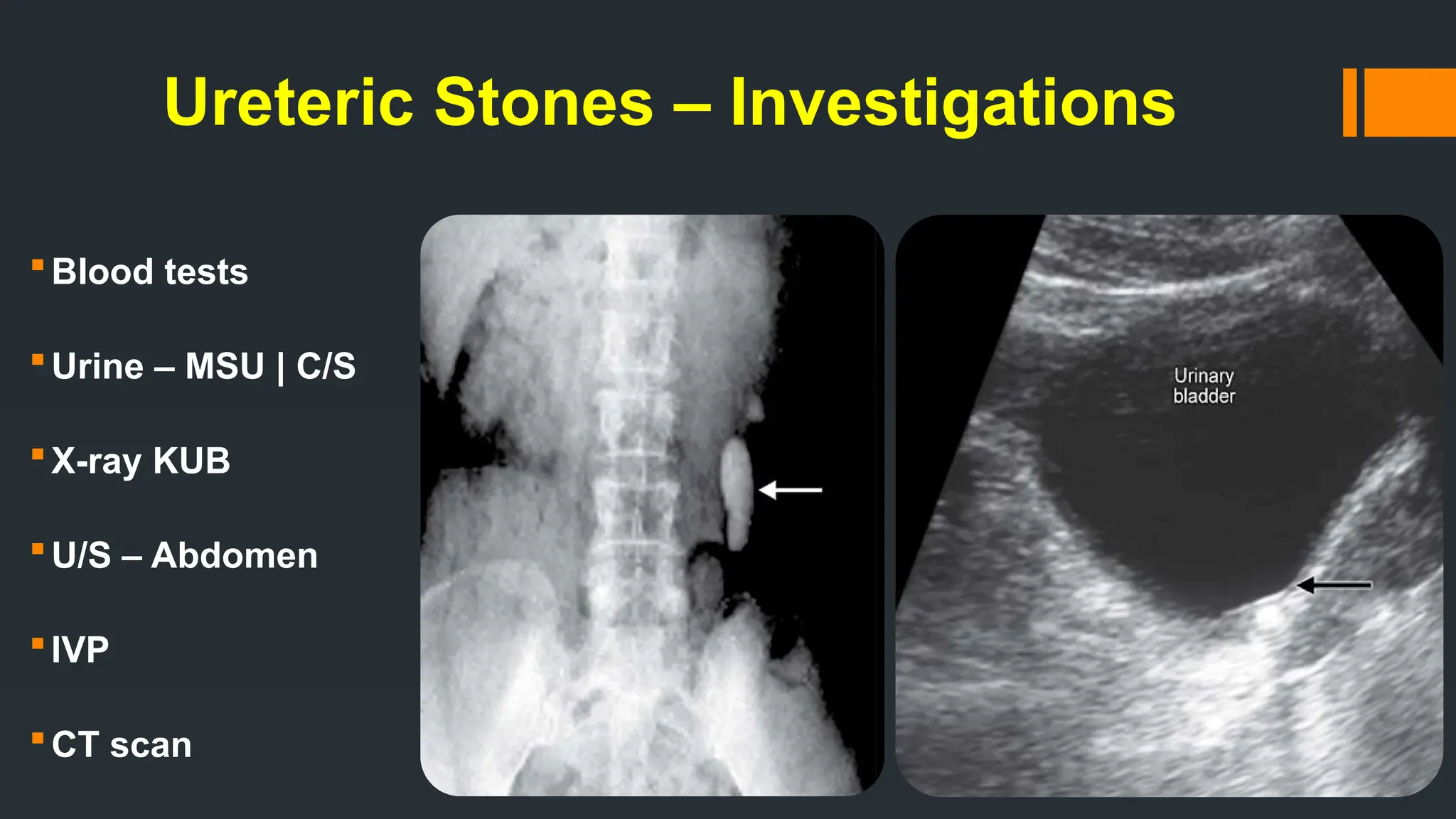 Ureteric Stones – Investigations
Blood tests
Urine – MSU | C/S
X-ray KUB
U/S – Abdomen
IVP
CT scan
 
