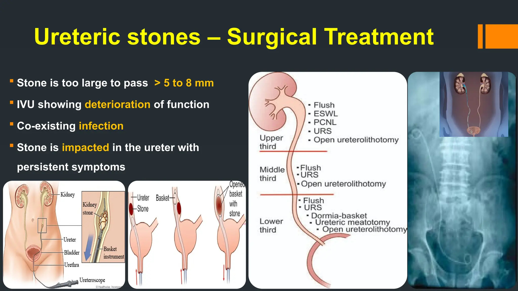 Ureteric stones – Surgical Treatment
 Stone is too large to pass > 5 to 8 mm
 IVU showing deterioration of function
 Co-existing infection
 Stone is impacted in the ureter with
persistent symptoms
 