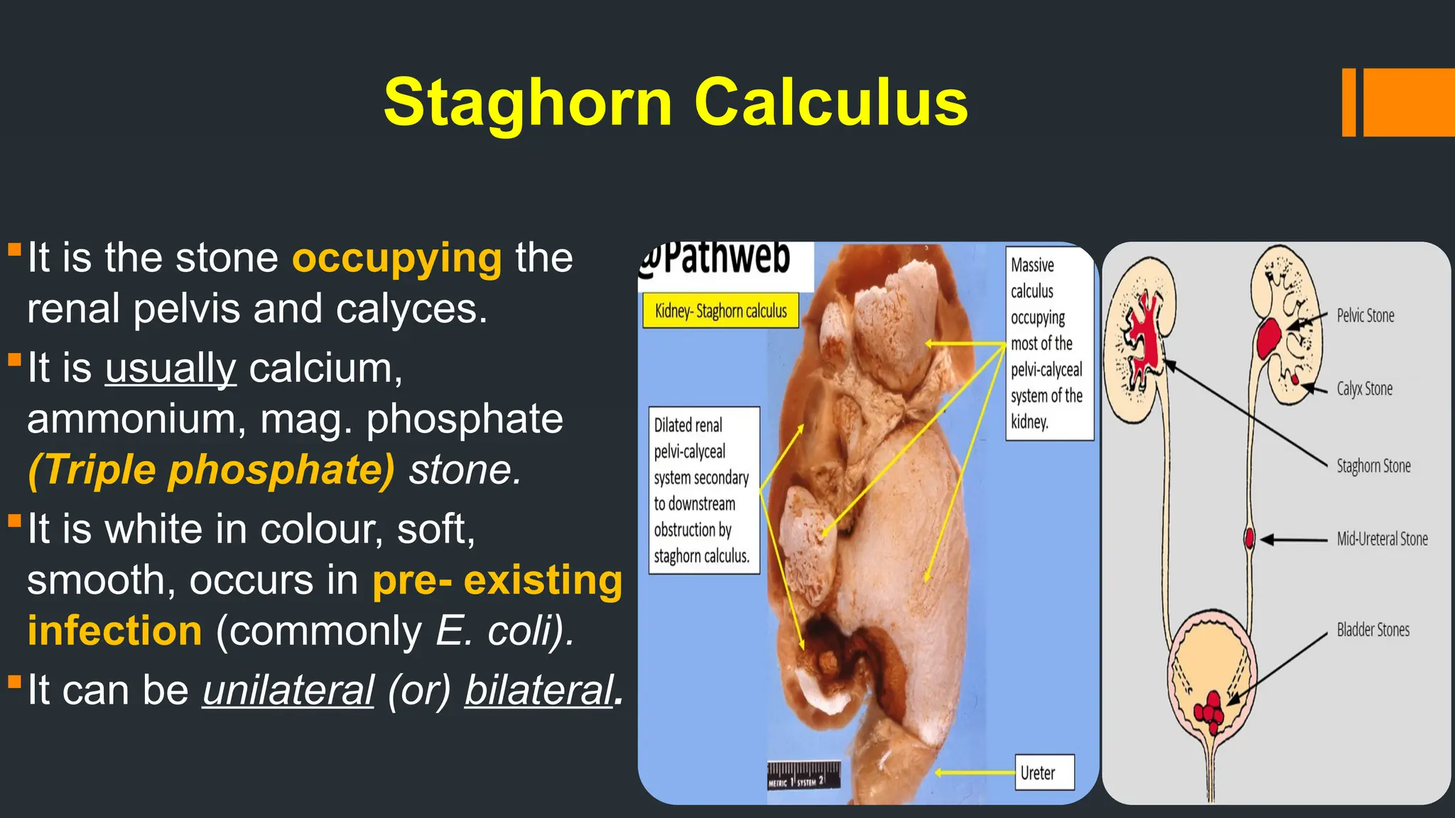 Staghorn Calculus
It is the stone occupying the
renal pelvis and calyces.
It is usually calcium,
ammonium, mag. phosphate
(Triple phosphate) stone.
It is white in colour, soft,
smooth, occurs in pre- existing
infection (commonly E. coli).
It can be unilateral (or) bilateral.
 