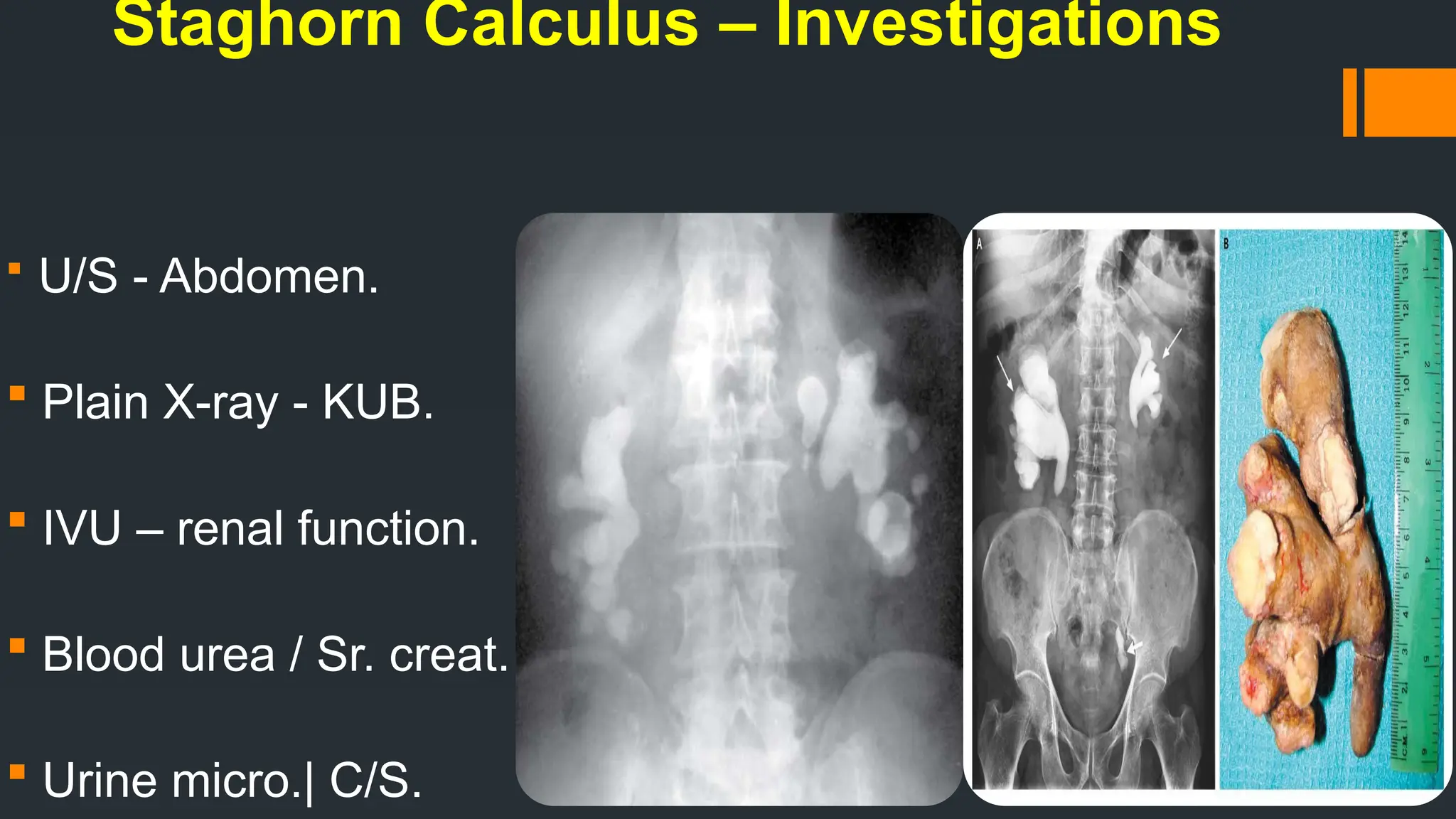 Staghorn Calculus – Investigations
 U/S - Abdomen.
 Plain X-ray - KUB.
 IVU – renal function.
 Blood urea / Sr. creat.
 Urine micro.| C/S.
 