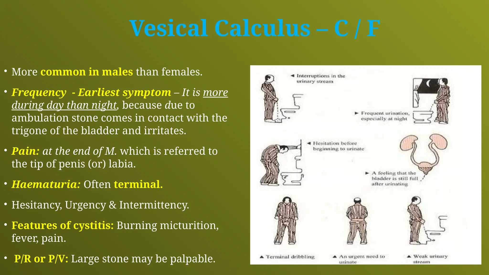 Vesical Calculus – C / F
• More common in males than females.
• Frequency - Earliest symptom – It is more
during day than night, because due to
ambulation stone comes in contact with the
trigone of the bladder and irritates.
• Pain: at the end of M. which is referred to
the tip of penis (or) labia.
• Haematuria: Often terminal.
• Hesitancy, Urgency & Intermittency.
• Features of cystitis: Burning micturition,
fever, pain.
• P/R or P/V: Large stone may be palpable.
 