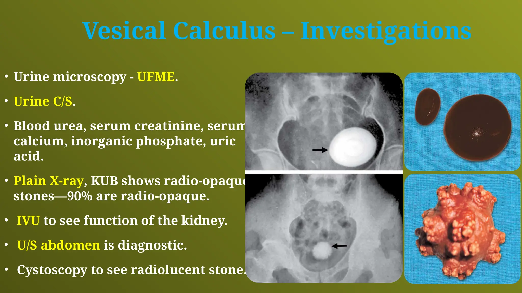 Vesical Calculus – Investigations
• Urine microscopy - UFME.
• Urine C/S.
• Blood urea, serum creatinine, serum
calcium, inorganic phosphate, uric
acid.
• Plain X-ray, KUB shows radio-opaque
stones—90% are radio-opaque.
• IVU to see function of the kidney.
• U/S abdomen is diagnostic.
• Cystoscopy to see radiolucent stone.
 