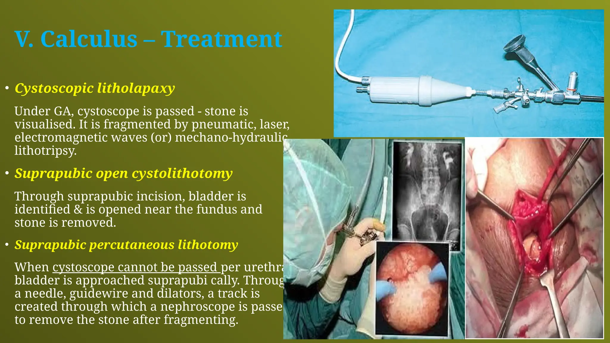 V. Calculus – Treatment
• Cystoscopic litholapaxy
Under GA, cystoscope is passed - stone is
visualised. It is fragmented by pneumatic, laser,
electromagnetic waves (or) mechano-hydraulic
lithotripsy.
• Suprapubic open cystolithotomy
Through suprapubic incision, bladder is
identified & is opened near the fundus and
stone is removed.
• Suprapubic percutaneous lithotomy
When cystoscope cannot be passed per urethra,
bladder is approached suprapubi cally. Through
a needle, guidewire and dilators, a track is
created through which a nephroscope is passed
to remove the stone after fragmenting.
 