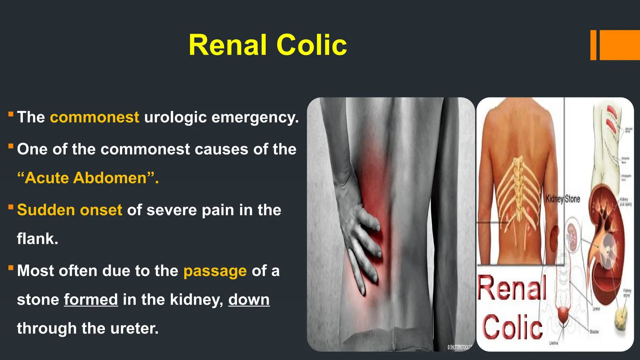 Renal Colic
The commonest urologic emergency.
One of the commonest causes of the
“Acute Abdomen”.
Sudden onset of severe pain in the
flank.
Most often due to the passage of a
stone formed in the kidney, down
through the ureter.
 