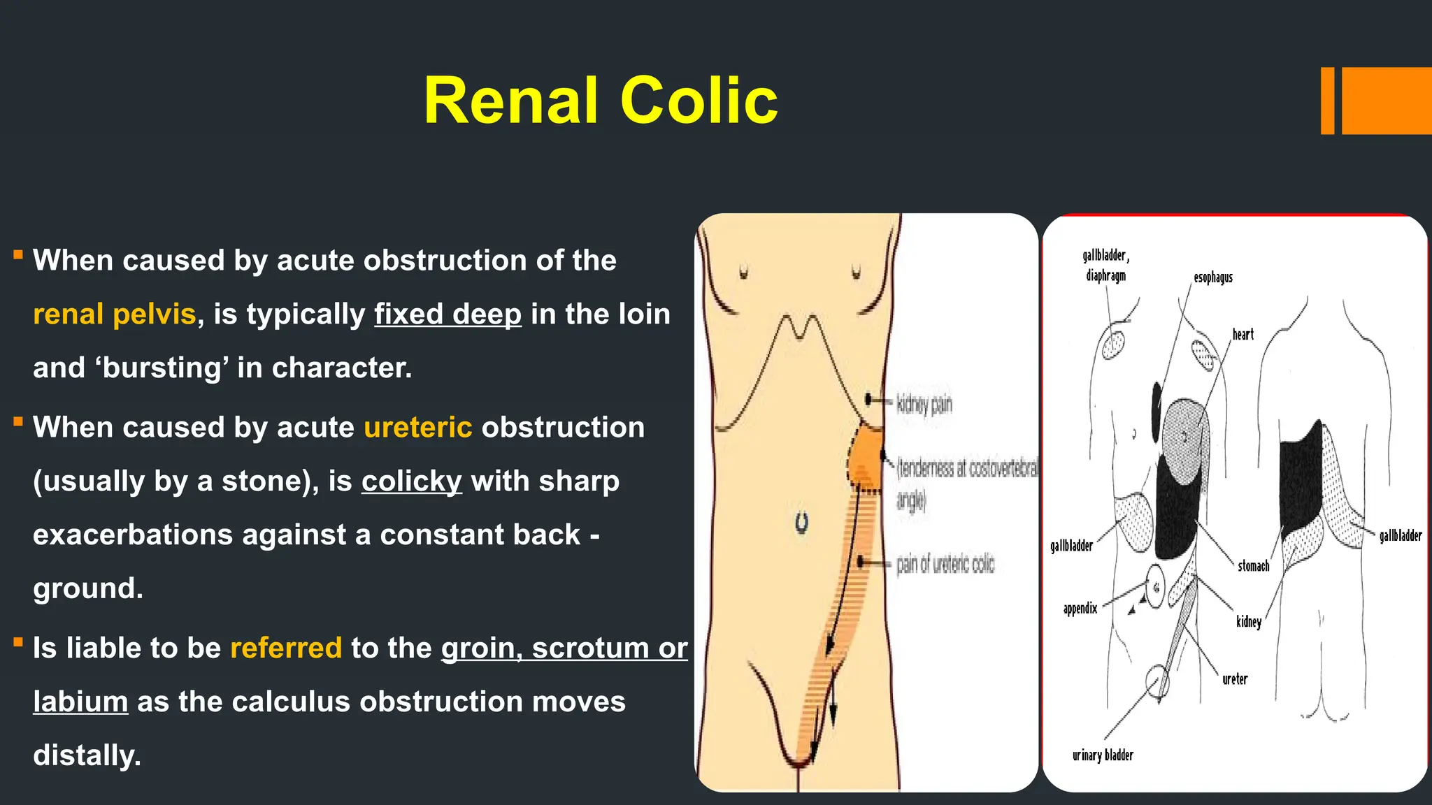 Renal Colic
 When caused by acute obstruction of the
renal pelvis, is typically fixed deep in the loin
and ‘bursting’ in character.
 When caused by acute ureteric obstruction
(usually by a stone), is colicky with sharp
exacerbations against a constant back -
ground.
 Is liable to be referred to the groin, scrotum or
labium as the calculus obstruction moves
distally.
 