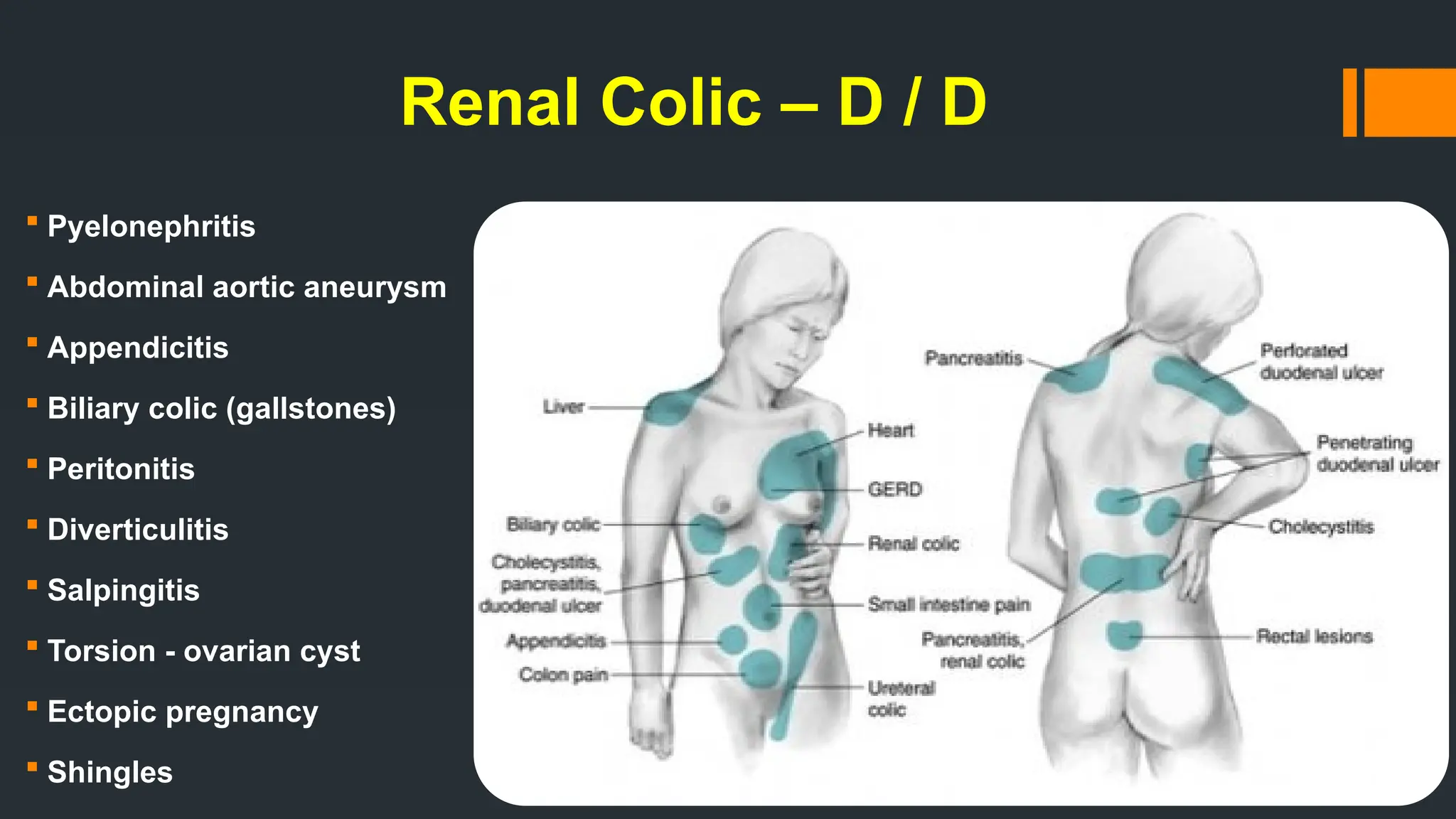 Renal Colic – D / D
 Pyelonephritis
 Abdominal aortic aneurysm
 Appendicitis
 Biliary colic (gallstones)
 Peritonitis
 Diverticulitis
 Salpingitis
 Torsion - ovarian cyst
 Ectopic pregnancy
 Shingles
 