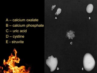 A – calcium oxalate
B – calcium phosphate
C – uric acid
D – cystine
E - struvite
 