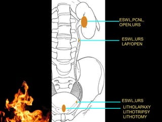 ESWL,PCNL,
OPEN,URS
ESWL,URS
LAP/OPEN
ESWL,URS
LITHOLAPAXY
LITHOTRIPSY
LITHOTOMY
 