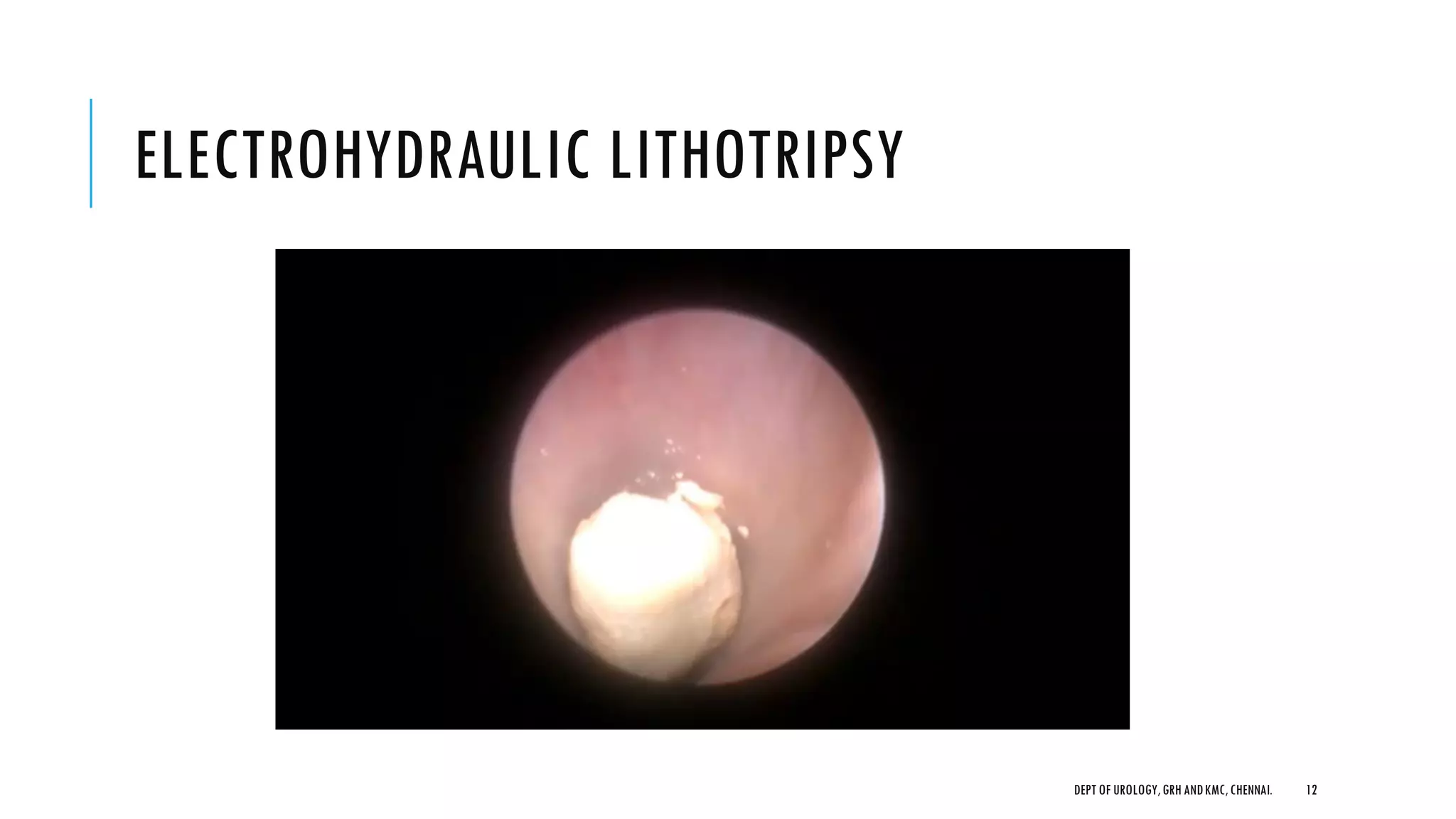 ELECTROHYDRAULIC LITHOTRIPSY
12
DEPT OF UROLOGY,GRH ANDKMC,CHENNAI.
 