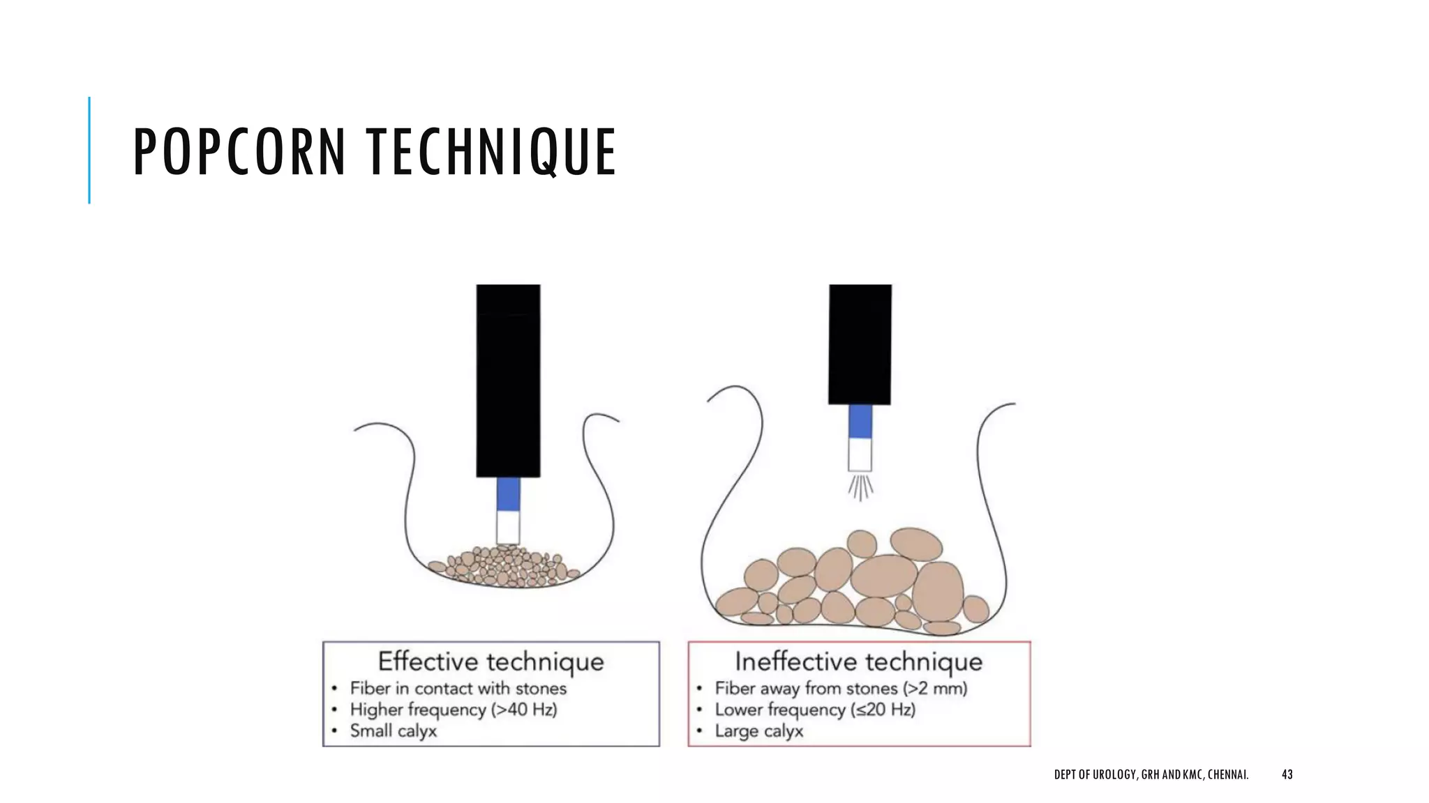 POPCORN TECHNIQUE
43
DEPT OF UROLOGY,GRH ANDKMC,CHENNAI.
 