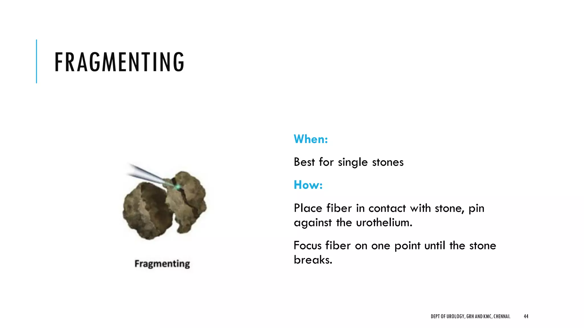 FRAGMENTING
When:
Best for single stones
How:
Place fiber in contact with stone, pin
against the urothelium.
Focus fiber on one point until the stone
breaks.
44
DEPT OF UROLOGY,GRH ANDKMC,CHENNAI.
 