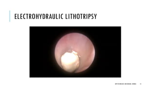 Urolithiasis management- icl. | PDF