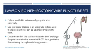 LAWSON RG NEPHROSTOMY WIRE PUNCTURE SET
 Make a small skin incision and grasp the wire
externally.
 Use the fascial dilators in an antegrade fashion until
theTorcon catheter can be advanced through the
tract.
 Once the end of the catheter exits the skin, exchange
the puncture wire for a standard 0.035 inch guidewire,
thus attaining through-and-through access.
103
DEPT OF UROLOGY, GRH AND KMC, CHENNAI.
 