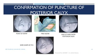 CONFIRMATION OF PUNCTURE OF
POSTERIOR CALYX
104
DEPT OF UROLOGY, GRH AND KMC, CHENNAI.
 