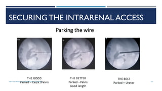 SECURING THE INTRARENAL ACCESS
107
DEPT OF UROLOGY, GRH AND KMC, CHENNAI.
 