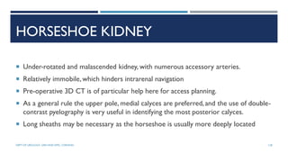HORSESHOE KIDNEY
 Under-rotated and malascended kidney, with numerous accessory arteries.
 Relatively immobile,which hinders intrarenal navigation
 Pre-operative 3D CT is of particular help here for access planning.
 As a general rule the upper pole, medial calyces are preferred,and the use of double-
contrast pyelography is very useful in identifying the most posterior calyces.
 Long sheaths may be necessary as the horseshoe is usually more deeply located
128
DEPT OF UROLOGY, GRH AND KMC, CHENNAI.
 