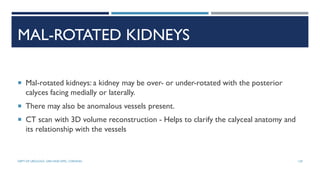 MAL-ROTATED KIDNEYS
 Mal-rotated kidneys: a kidney may be over- or under-rotated with the posterior
calyces facing medially or laterally.
 There may also be anomalous vessels present.
 CT scan with 3D volume reconstruction - Helps to clarify the calyceal anatomy and
its relationship with the vessels
129
DEPT OF UROLOGY, GRH AND KMC, CHENNAI.
 