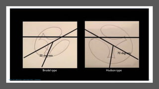 20 degrees
70 degrees
Brodel type Hudson type
15
DEPT OF UROLOGY, GRH AND KMC, CHENNAI.
 