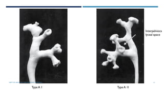 Type A 1 Type A 1I
Interpelvioca
lyceal space
21
DEPT OF UROLOGY, GRH AND KMC, CHENNAI.
 