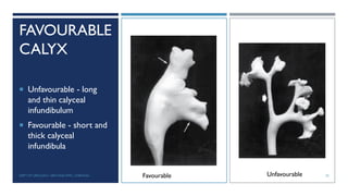 FAVOURABLE
CALYX
 Unfavourable - long
and thin calyceal
infundibulum
 Favourable - short and
thick calyceal
infundibula
Favourable Unfavourable 25
DEPT OF UROLOGY, GRH AND KMC, CHENNAI.
 