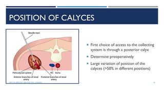 POSITION OF CALYCES
 First choice of access to the collecting
system is through a posterior calyx
 Determine preoperatively
 Large variation of position of the
calyces (>50% in different positions)
26
DEPT OF UROLOGY, GRH AND KMC, CHENNAI.
 
