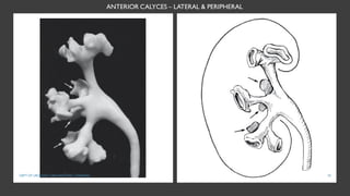ANTERIOR CALYCES – LATERAL & PERIPHERAL
29
DEPT OF UROLOGY, GRH AND KMC, CHENNAI.
 
