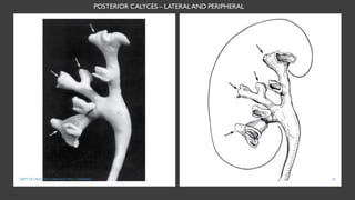 POSTERIOR CALYCES – LATERALAND PERIPHERAL
30
DEPT OF UROLOGY, GRH AND KMC, CHENNAI.
 