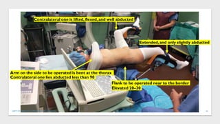 Flank to be operated near to the border
Elevated 20–30
Extended,and only slightly abducted
Contralateral one is lifted, flexed,and well abducted
Arm on the side to be operated is bent at the thorax
Contralateral one lies abducted less than 90
43
DEPT OF UROLOGY, GRH AND KMC, CHENNAI.
 