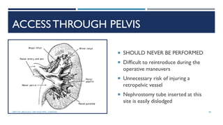 ACCESSTHROUGH PELVIS
 SHOULD NEVER BE PERFORMED
 Difficult to reintroduce during the
operative maneuvers
 Unnecessary risk of injuring a
retropelvic vessel
 Nephrostomy tube inserted at this
site is easily dislodged
48
DEPT OF UROLOGY, GRH AND KMC, CHENNAI.
 