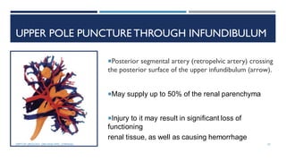 UPPER POLE PUNCTURE THROUGH INFUNDIBULUM
Posterior segmental artery (retropelvic artery) crossing
the posterior surface of the upper infundibulum (arrow).
May supply up to 50% of the renal parenchyma
Injury to it may result in significant loss of
functioning
renal tissue, as well as causing hemorrhage
52
DEPT OF UROLOGY, GRH AND KMC, CHENNAI.
 