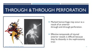 THROUGH &THROUGH PERFORATION
 Marked hemorrhage may occur as a
result of an anterior
through‐and‐through perforation.
 Effective tamponade of injured
anterior vessels is difficult because
they lie distantly in the nephrostomy
tract
54
DEPT OF UROLOGY, GRH AND KMC, CHENNAI.
 