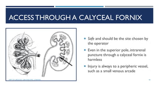 ACCESS THROUGH A CALYCEAL FORNIX
 Safe and should be the site chosen by
the operator
 Even in the superior pole, intrarenal
puncture through a calyceal fornix is
harmless
 Injury is always to a peripheric vessel,
such as a small venous arcade
58
DEPT OF UROLOGY, GRH AND KMC, CHENNAI.
 
