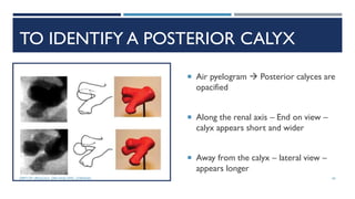 TO IDENTIFY A POSTERIOR CALYX
 Air pyelogram  Posterior calyces are
opacified
 Along the renal axis – End on view –
calyx appears short and wider
 Away from the calyx – lateral view –
appears longer
65
DEPT OF UROLOGY, GRH AND KMC, CHENNAI.
 