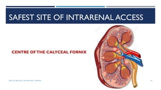 SAFEST SITE OF INTRARENAL ACCESS
CENTRE OFTHE CALYCEAL FORNIX
70
DEPT OF UROLOGY, GRH AND KMC, CHENNAI.
 