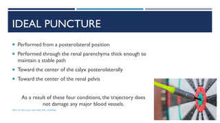 IDEAL PUNCTURE
 Performed from a posterolateral position
 Performed through the renal parenchyma thick enough to
maintain a stable path
 Toward the center of the calyx posterolaterally
 Toward the center of the renal pelvis
As a result of these four conditions, the trajectory does
not damage any major blood vessels.
72
DEPT OF UROLOGY, GRH AND KMC, CHENNAI.
 