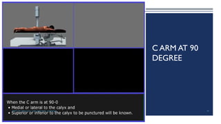 C ARM AT 90
DEGREE
79
DEPT OF UROLOGY, GRH AND KMC, CHENNAI.
 