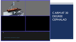 C ARM AT 30
DEGREE
CEPHALAD
82
DEPT OF UROLOGY, GRH AND KMC, CHENNAI.
 